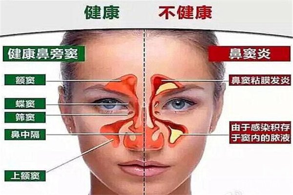 开一家鼻炎店赚钱吗